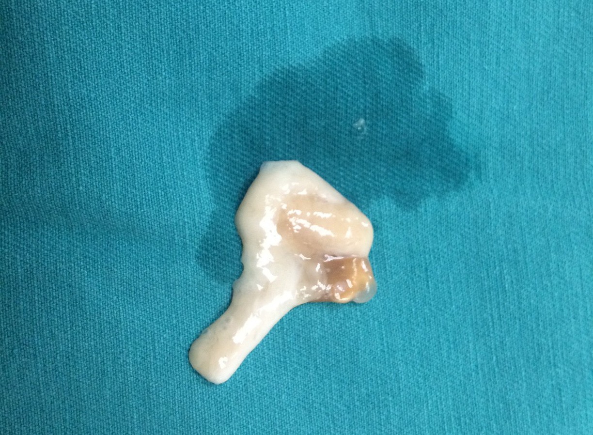 Thanh niên nghiện tiết canh bị hôn mê vì sán "ăn" não
