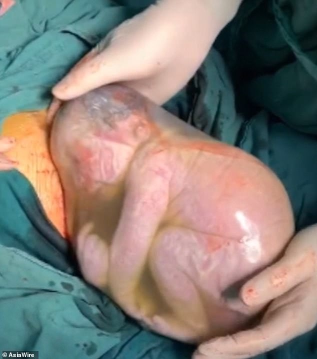 Chào đời trong "bọc điều", bé trai không thở suốt 2 phút