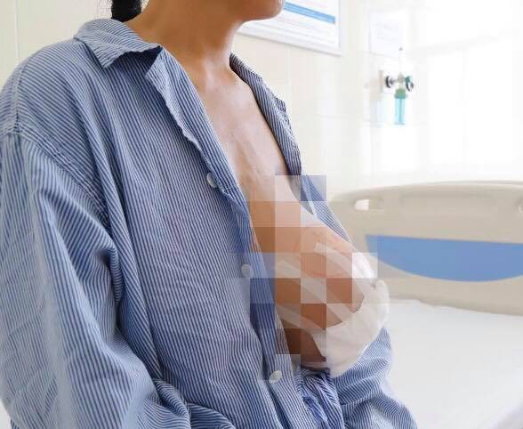 Bầu ngực sắp nổ tung sau khi đắp l&aacute; chữa u v&uacute; - Ảnh 2.