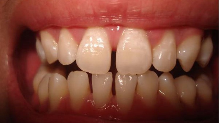 "Lấp đầy" răng thưa, cách nào rẻ nhất?