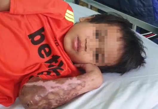 Vụ bác sĩ năn nỉ được cứu chữa cháu bé phỏng nặng: A Huyên đã bình phục, xuất viện