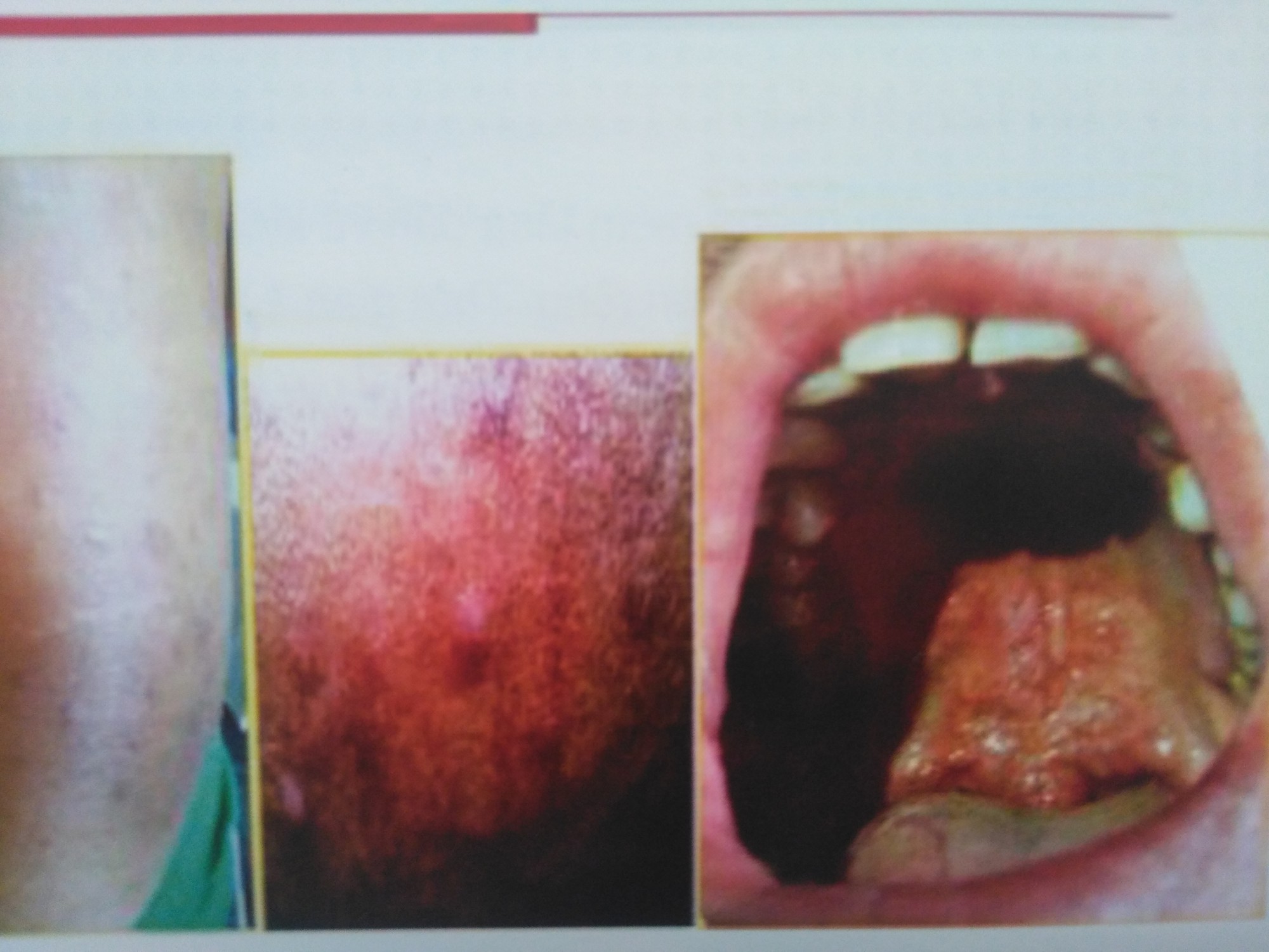 Công bố mới về bệnh phong: Bắt chước nhiều bệnh, dễ chẩn đoán nhầm