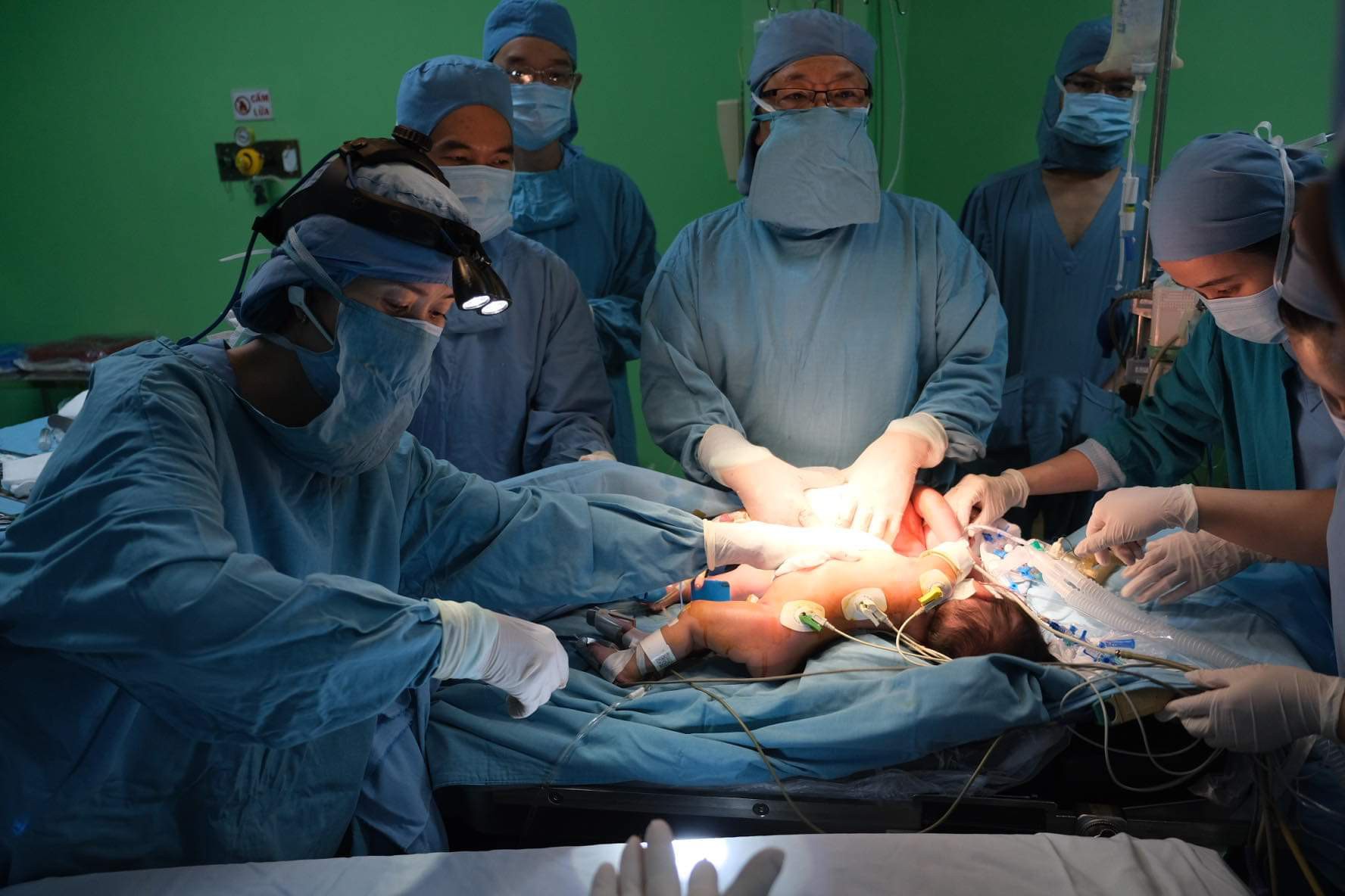 Sau nhiều giờ 'đánh vật" các bác sĩ đã tách thành công 2 bé gái dính chặt nhau