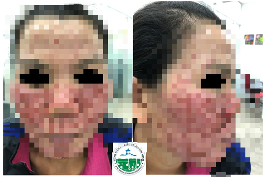 Bong tróc da mặt do tự lột da làm đẹp