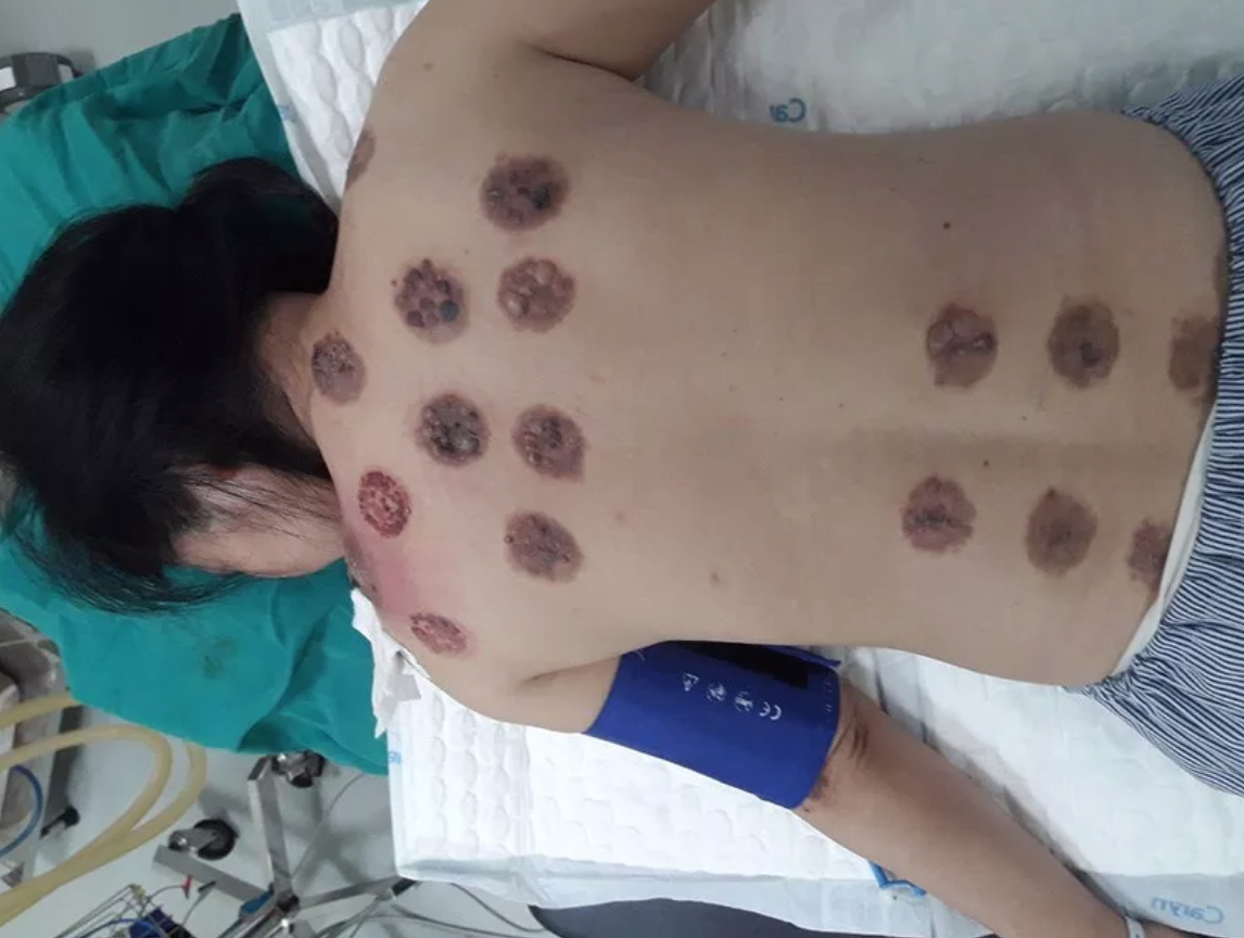 Giác hơi trị mỏi vai gáy, người phụ nữ bị hoại tử cả mảng lưng