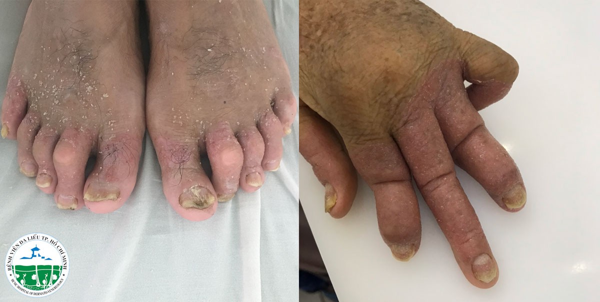Biến dạng toàn thân do uống thuốc "thầy lang" trị vảy nến