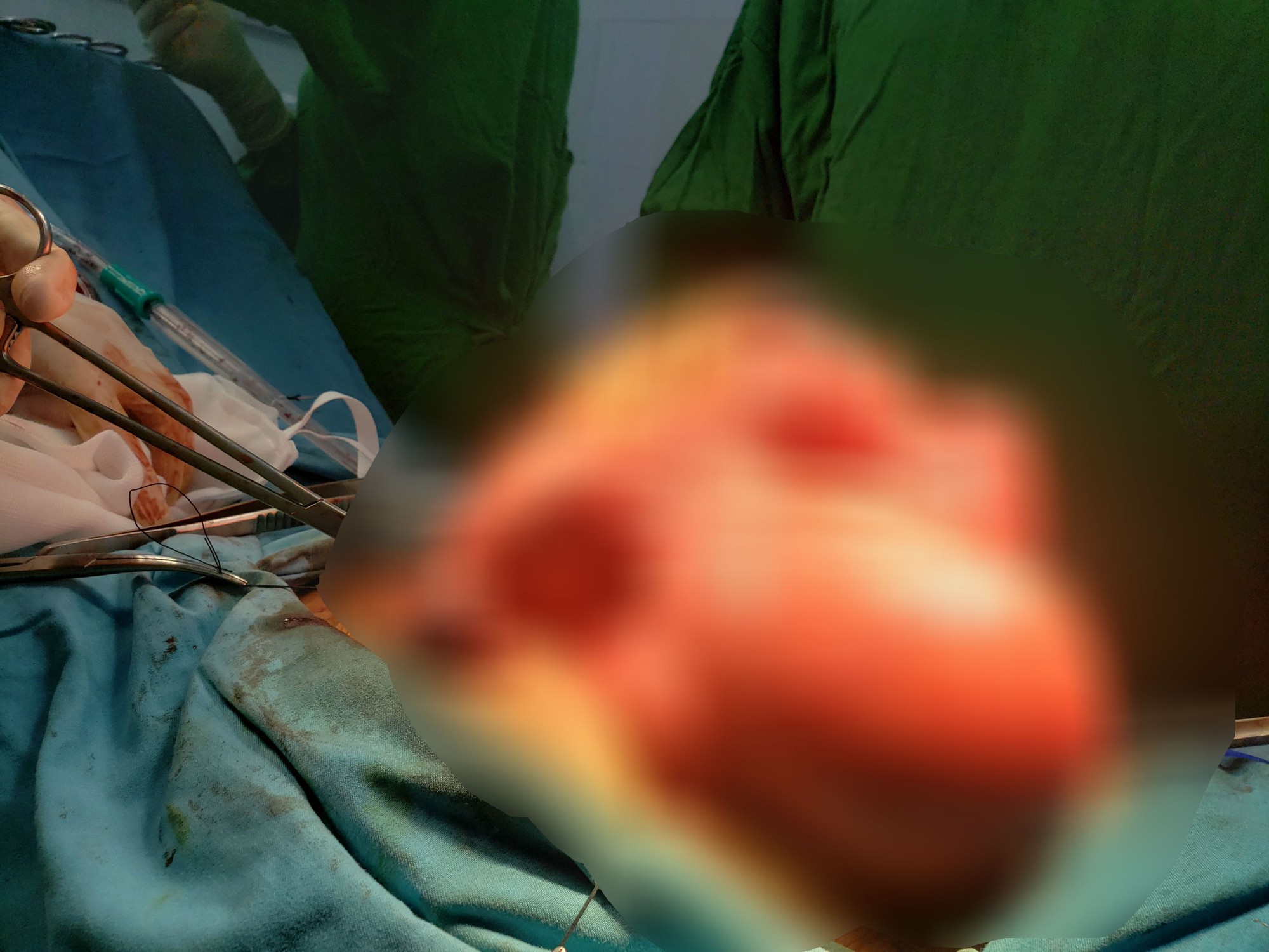Chặn khối u 6 kg phát triển âm thầm trong một phụ nữ
