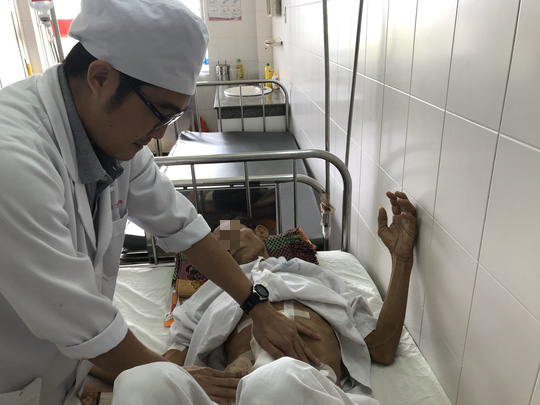 Hi hữu lấy nhiều vi&ecirc;n sỏi dạng san h&ocirc; trong ống tụy bệnh nh&acirc;n ung thư - Ảnh 2.