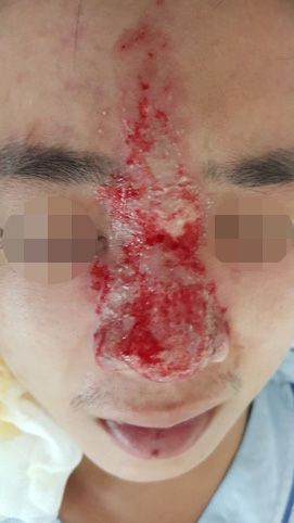 Người đàn ông có nguy cơ mù mắt sau khi tiêm filler nâng mũi làm đẹp