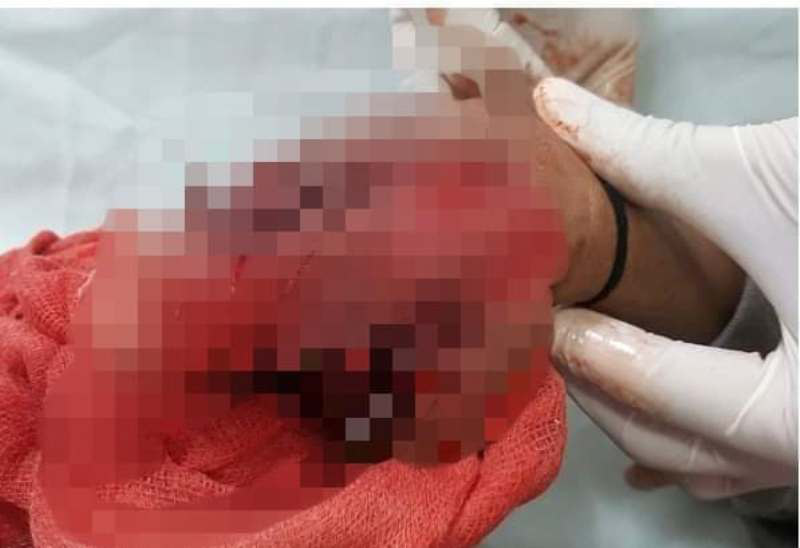 Cắt bỏ bàn tay dập nát của bé trai 9 tuổi do đèn pin phát nổ gây ra