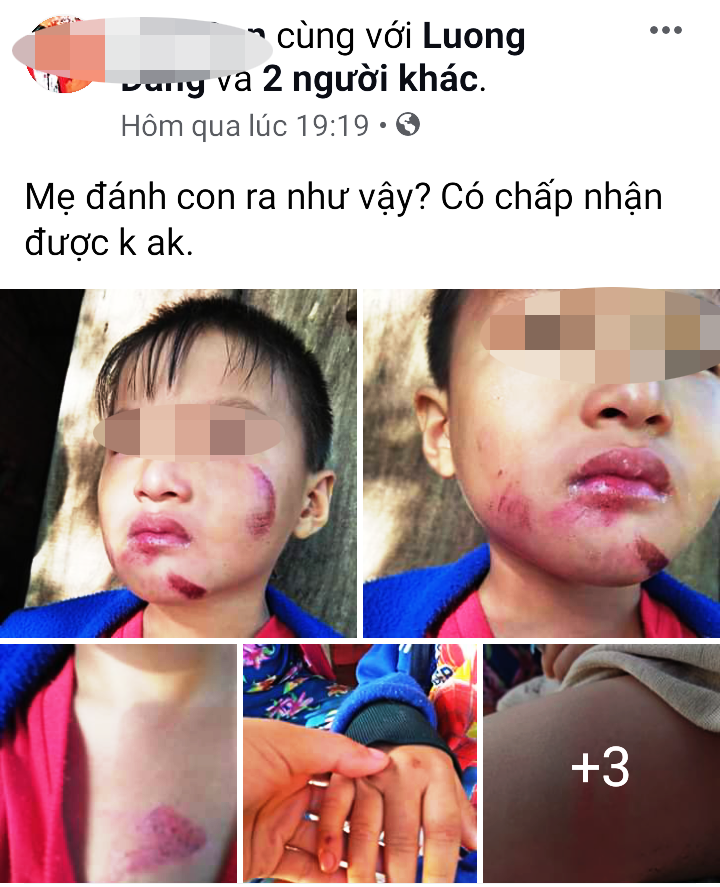 Một cháu bé 6 tuổi nghi bị chính mẹ ruột đánh dã man