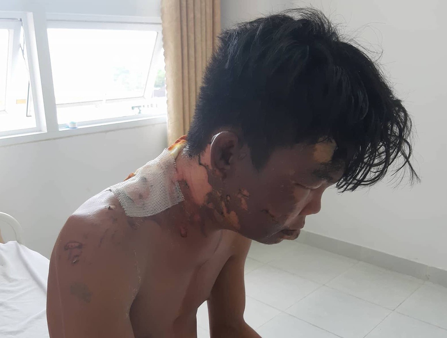 Lí do khiến chị gái đổ nước sôi lên người em trai gây bỏng nặng