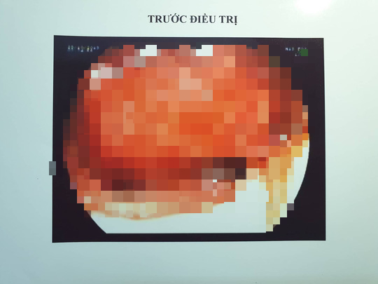 5 ph&uacute;t cứu sống bệnh nh&acirc;n n&ocirc;n 1 l&iacute;t m&aacute;u đỏ tươi bằng kỹ thuật mới - Ảnh 1.
