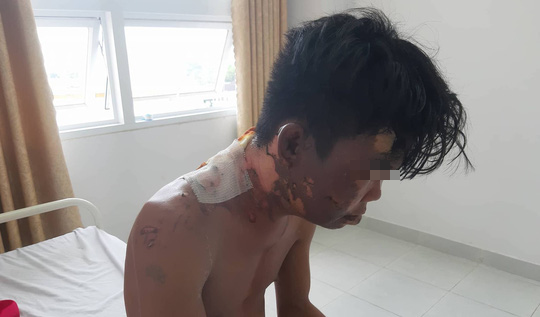 Lí do khiến chị gái đổ nước sôi lên người em trai gây bỏng nặng - Ảnh 1.