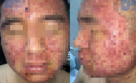 Mặt nam thanh niên 22 tuổi chi chít mụn trứng cá sau khi bôi thuốc mua trên mạng