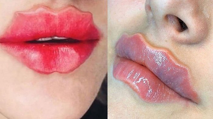Bờ môi lượn sóng kỳ quái đang gây sốt