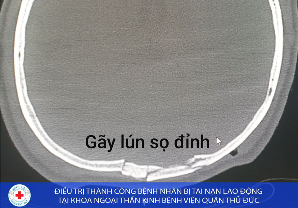 Cứu sống người đàn ông bị vật nặng rơi từ trên cao xuống  lún sọ