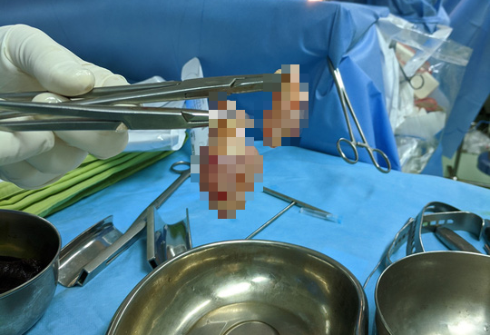 Khối u như đùi ếch bám vào tim suýt đoạt mạng cụ bà 80 tuổi