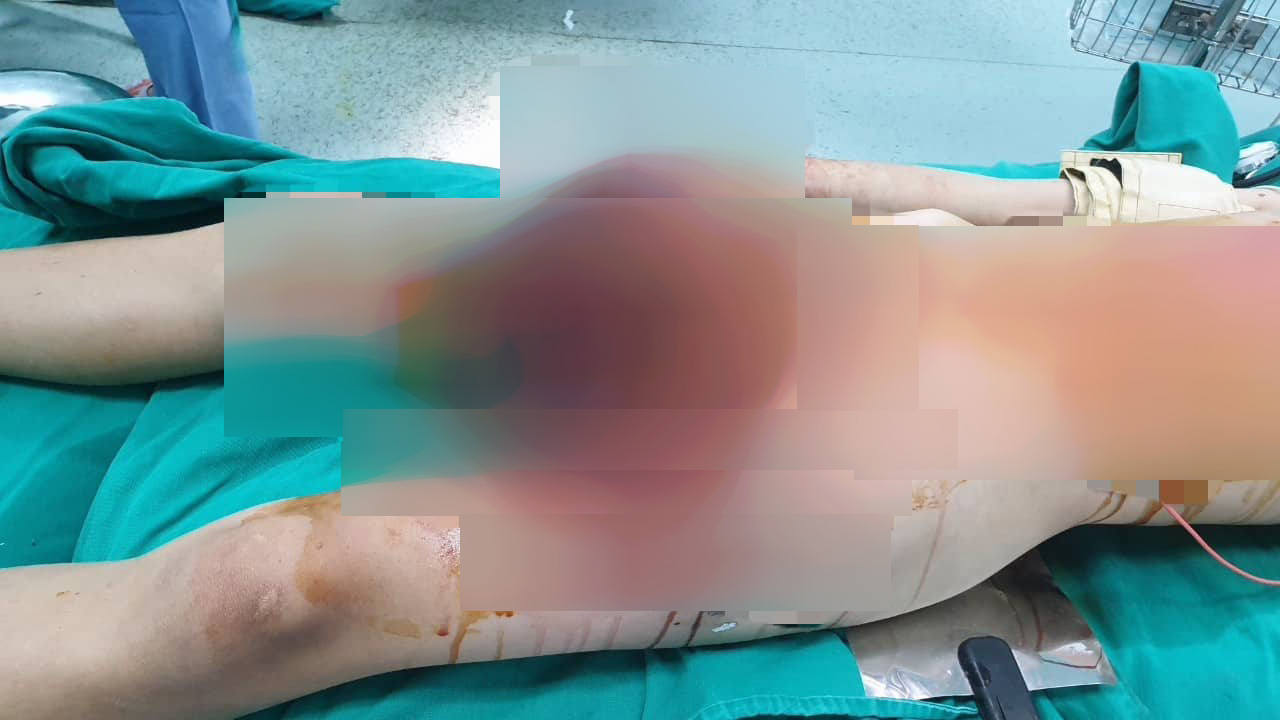 Học chế thuốc pháo trên mạng, nam sinh 13 tuổi dập nát bàn tay phải và 2 bên đùi