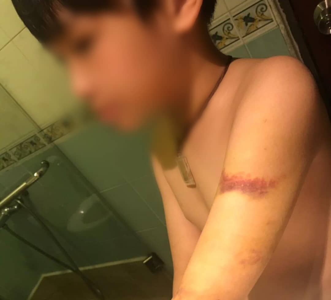 Xử lý hành chính người cha dùng cây đánh con bầm mình
