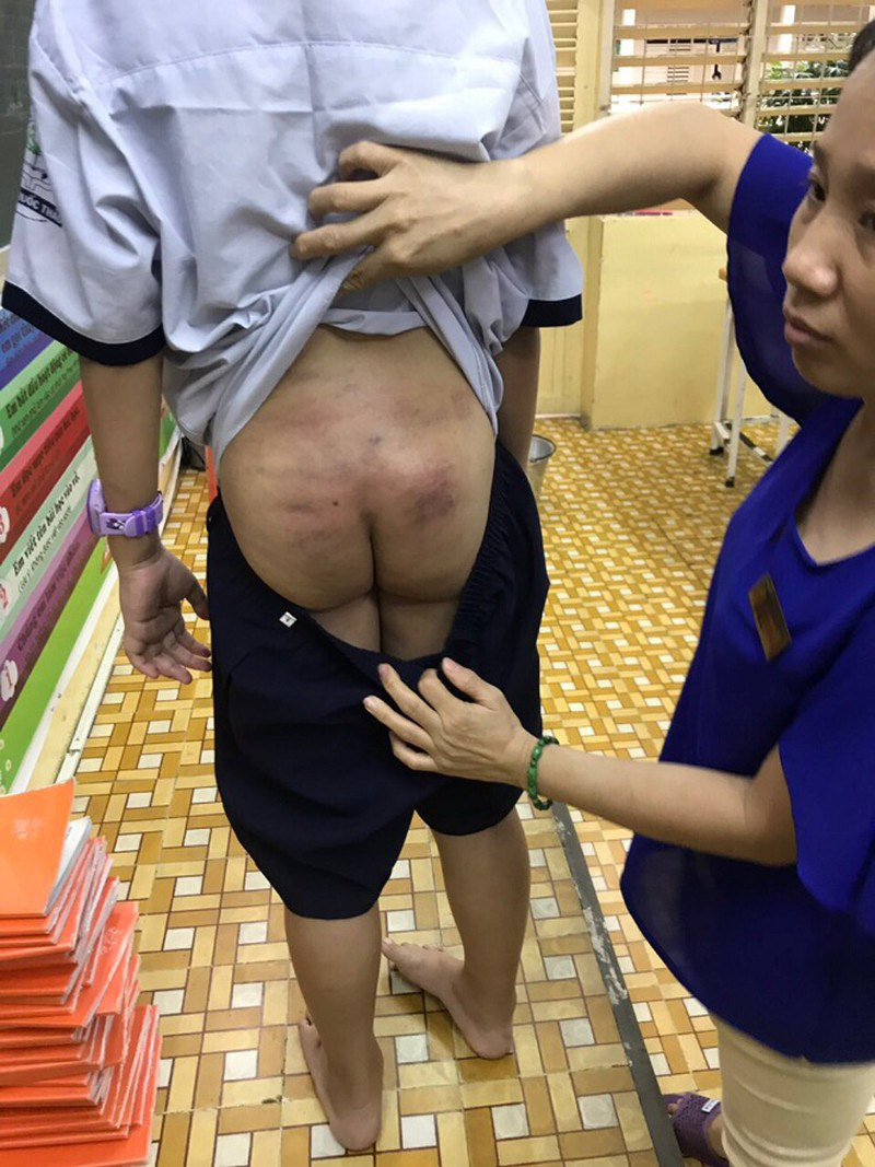 Xử lý hành chính người cha dùng cây đánh con bầm mình - Ảnh 2.