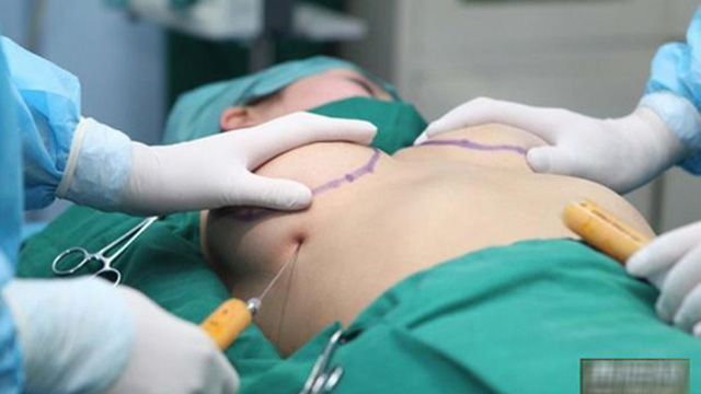 Cô gái trẻ ở TP HCM  bị vỡ 2 túi độn ngực cùng lúc