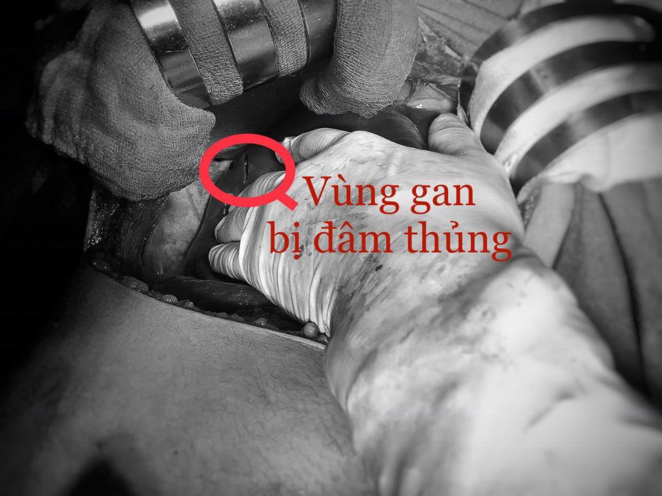 Cứu sống bệnh nhân bị đâm thủng tim, gan