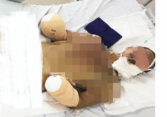 Công an Hải Phòng lên tiếng nghi án nam thanh niên cụt 2 tay do sản xuất pháo