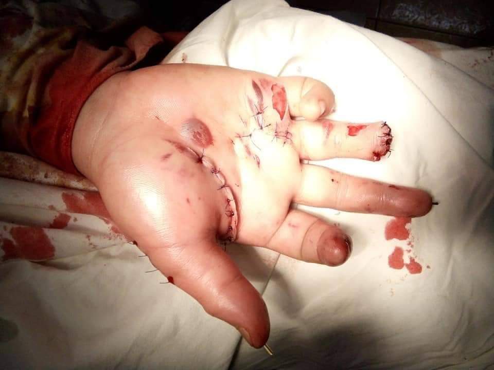 Đêm giao thừa, nhiều trường hợp bị mù, bỏng do pháo hoa gây ra - Ảnh 1.