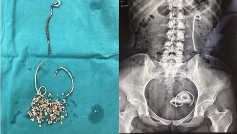 Bị đái rắt suốt 5 năm do bỏ quên stent trong niệu đạo - Ảnh 1.