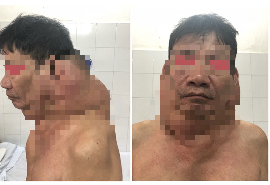 "Người gấu" được phẫu thuật thành công khối u khổng lồ