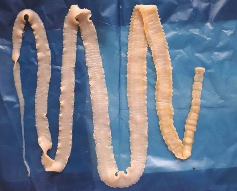Số trẻ dương t&iacute;nh với ấu tr&ugrave;ng s&aacute;n lợn tăng l&ecirc;n 209 trường hợp - Ảnh 3.