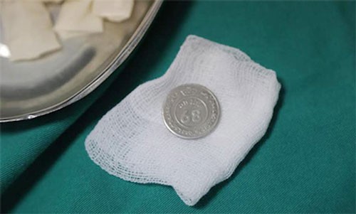 Thiếu niên 14 tuổi bị hóc đồng xu