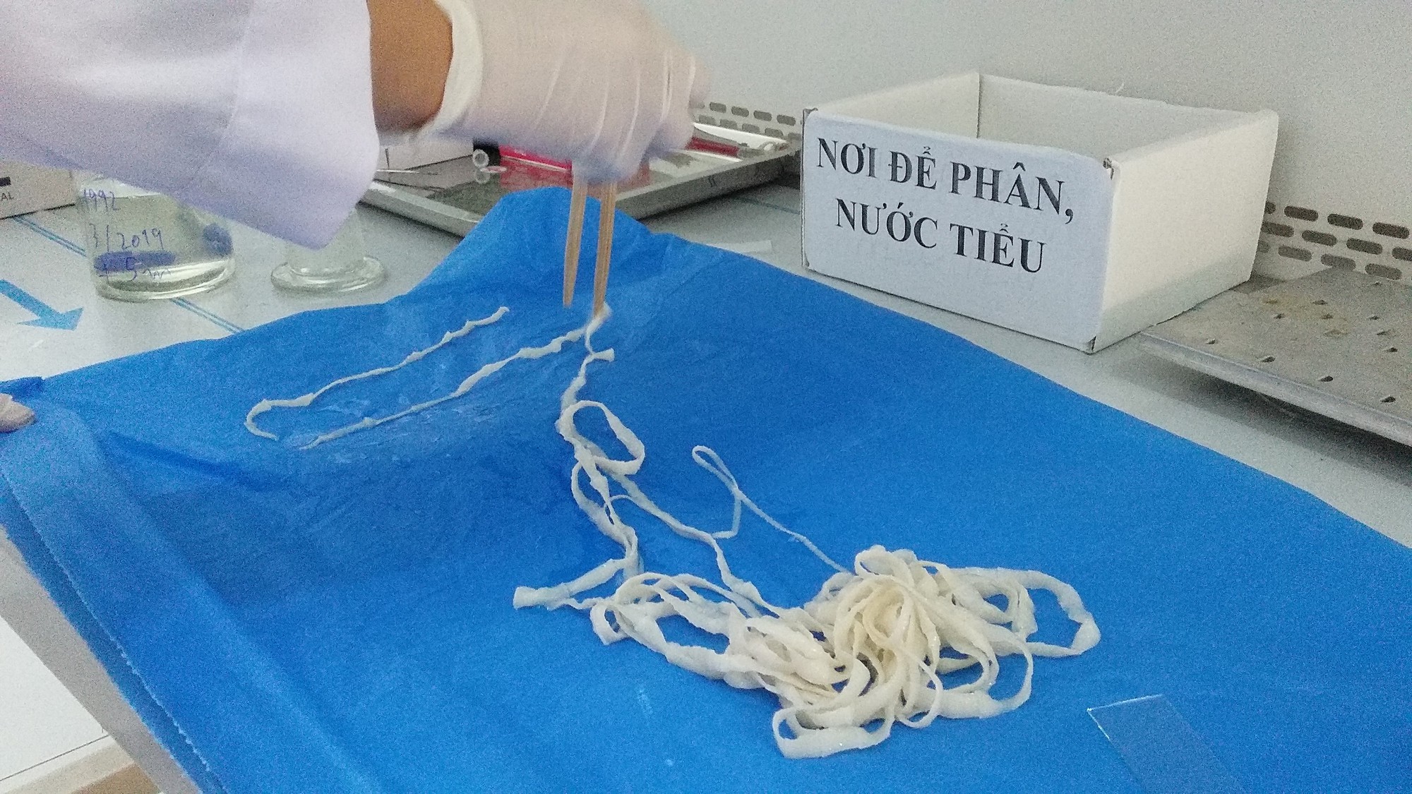 "Bắt" sán dây dài hơn 5 m khỏi cơ thể nữ giáo viên