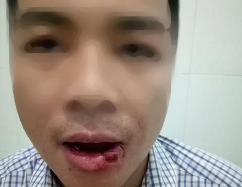 Thầy gi&aacute;o n&eacute;m thanh sắt l&agrave;m h&agrave;ng x&oacute;m l&agrave; nh&acirc;n vi&ecirc;n t&ograve;a &aacute;n g&atilde;y 5 chiếc răng - Ảnh 1.