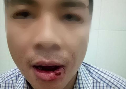 Thầy giáo ném thanh sắt làm hàng xóm là nhân viên tòa án gãy 5 chiếc răng