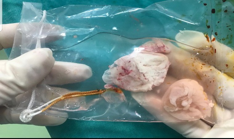 Bắt ổ sán lớn ở não, người đàn ông thoát cảnh liệt nửa người