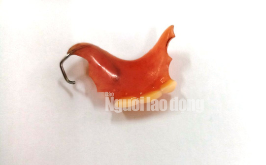 Hy hữu nuốt luôn hàm răng giả trong lúc ăn sáng - Ảnh 1.