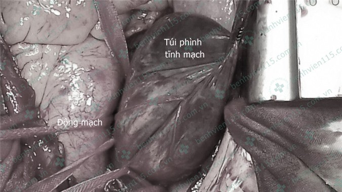Ngực su&yacute;t nổ banh v&igrave; t&uacute;i m&aacute;u khổng lồ - Ảnh 1.