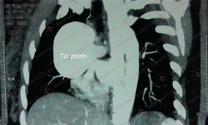 Ngực suýt "nổ banh" vì túi máu khổng lồ