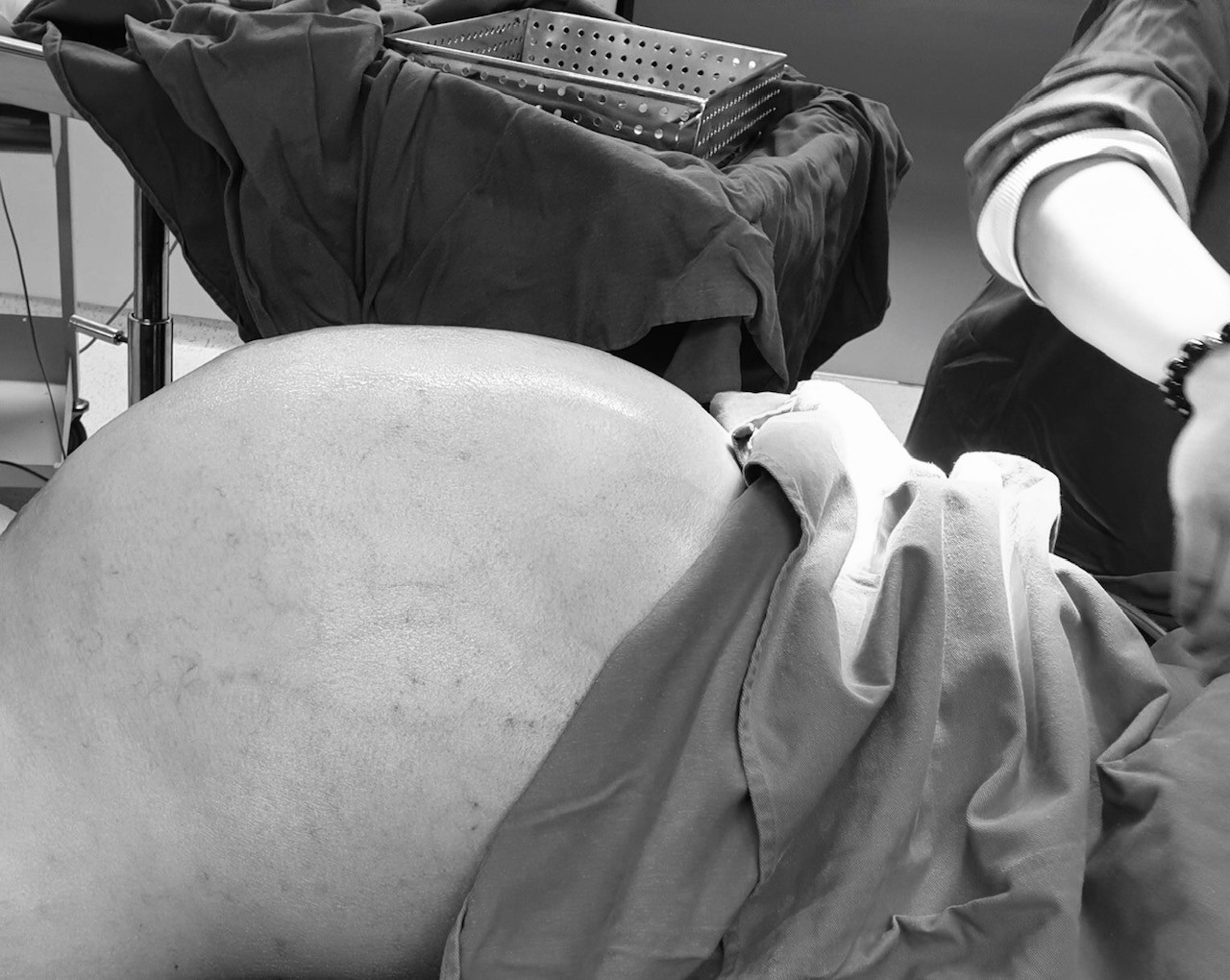 Cắt khối u khủng 25 kg trong bụng của thanh ni&ecirc;n 9x - Ảnh 1.