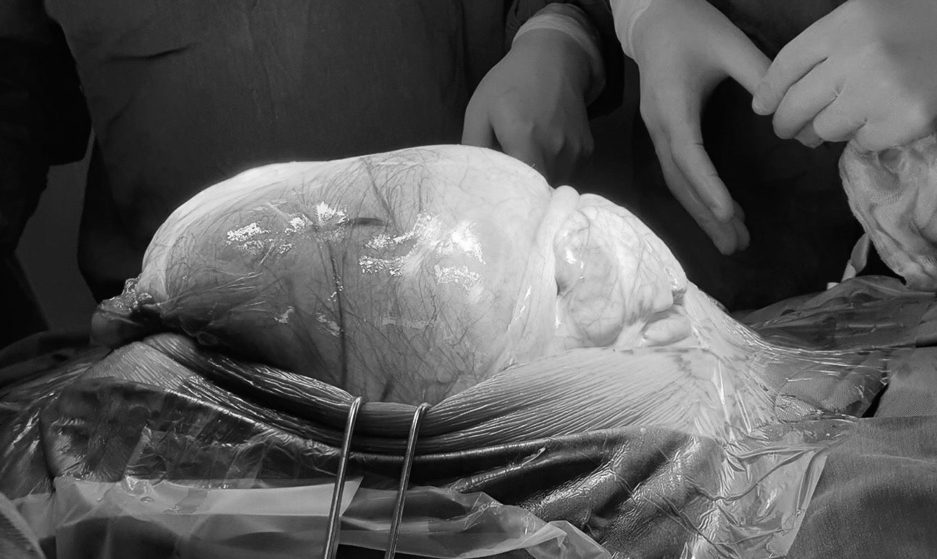 Cắt khối u "khủng" 25 kg trong bụng của thanh niên 9x
