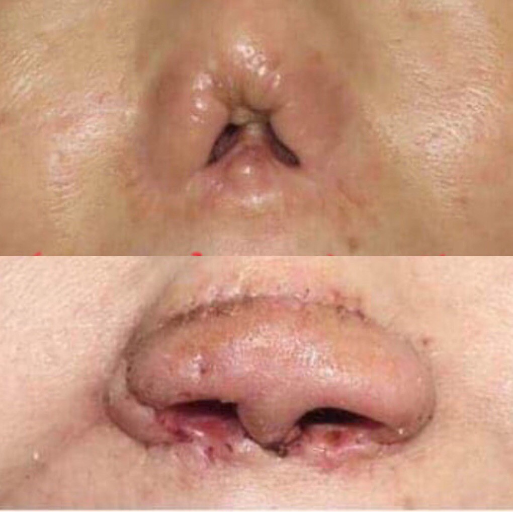 Lần đầu tiên tạo lại cánh mũi bằng vành tai
