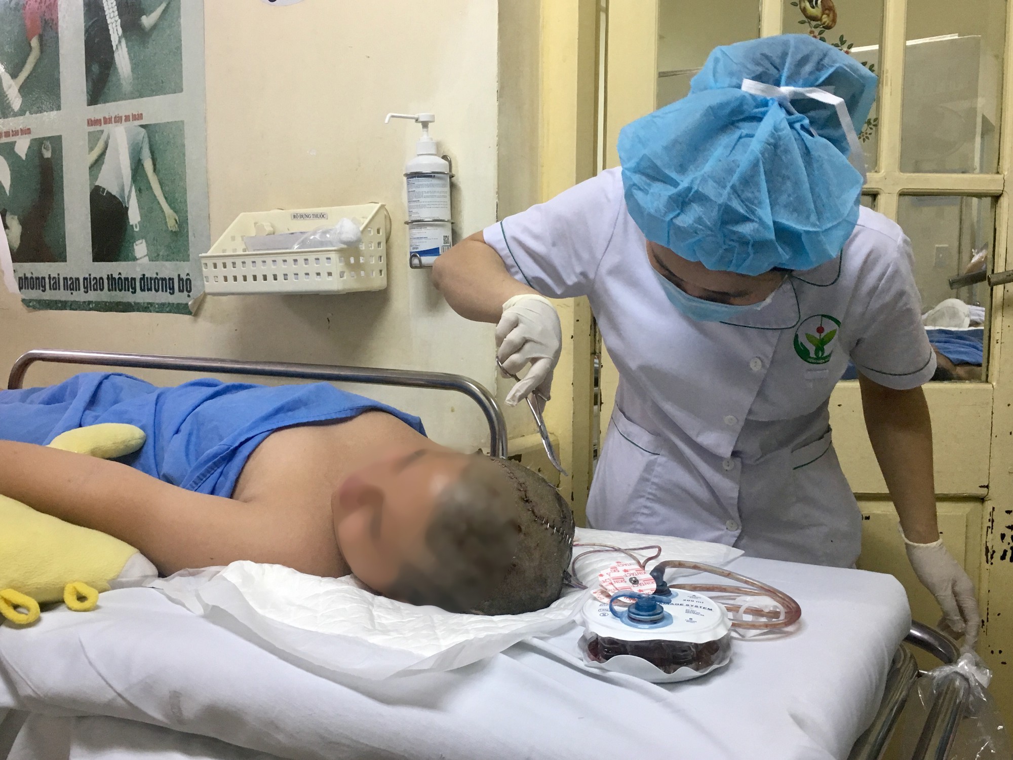 Học sinh lớp 6 bị 2 thanh sắt cắm v&agrave;o đầu khi nhảy cao phải phẫu thuật tạo h&igrave;nh hộp sọ - Ảnh 1.