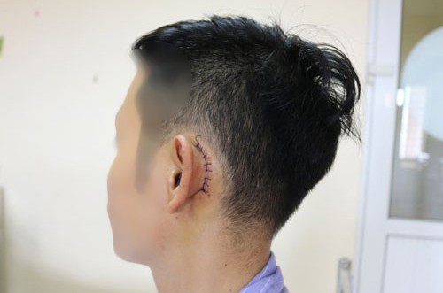 Sạc điện thoại bên gối, nam thanh niên thủng màng nhĩ