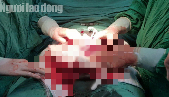 Mang thai lần 3, sản phụ 40 tuổi su&yacute;t mất mạng v&igrave; vỡ tử cung - Ảnh 2.