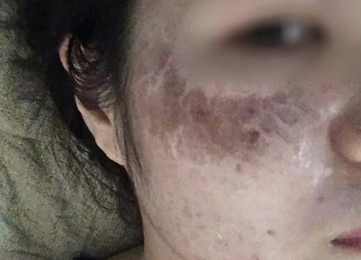 C&ocirc; g&aacute;i sắp cưới bị bỏng axit, mặt chi ch&iacute;t mụn nước sau khi &ldquo;peel da&rdquo; tại nh&agrave; - Ảnh 2.