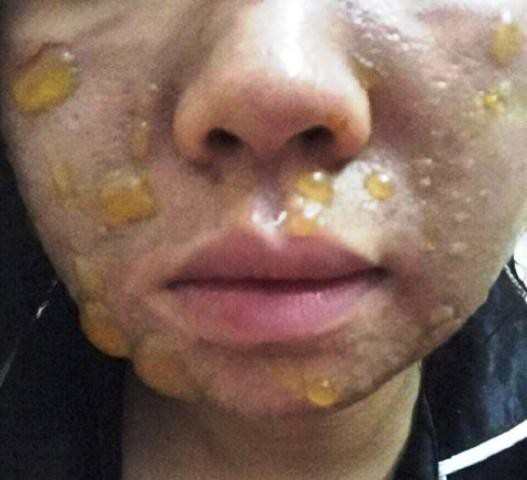 C&ocirc; g&aacute;i sắp cưới bị bỏng axit, mặt chi ch&iacute;t mụn nước sau khi &ldquo;peel da&rdquo; tại nh&agrave; - Ảnh 1.