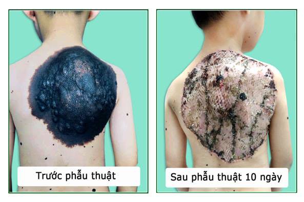 Kinh hãi bé trai 7 tuổi bị u hắc tố khổng lồ ăn cả lưng - Ảnh 1.