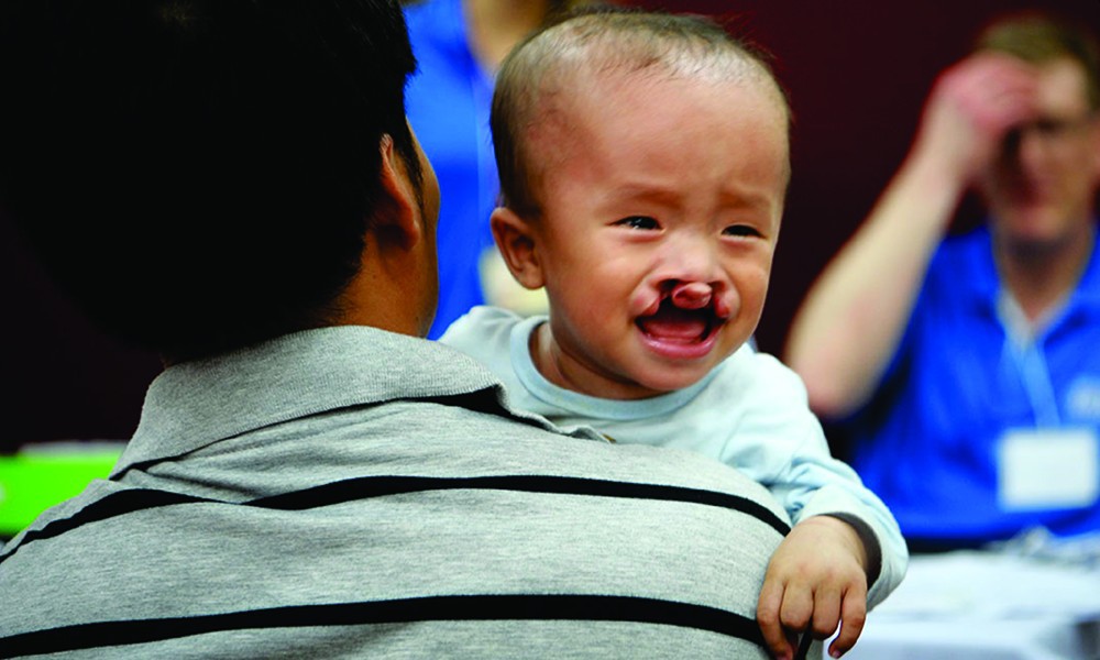 Bình Dương: Phẫu thuật miễn phí cho công nhân lao động